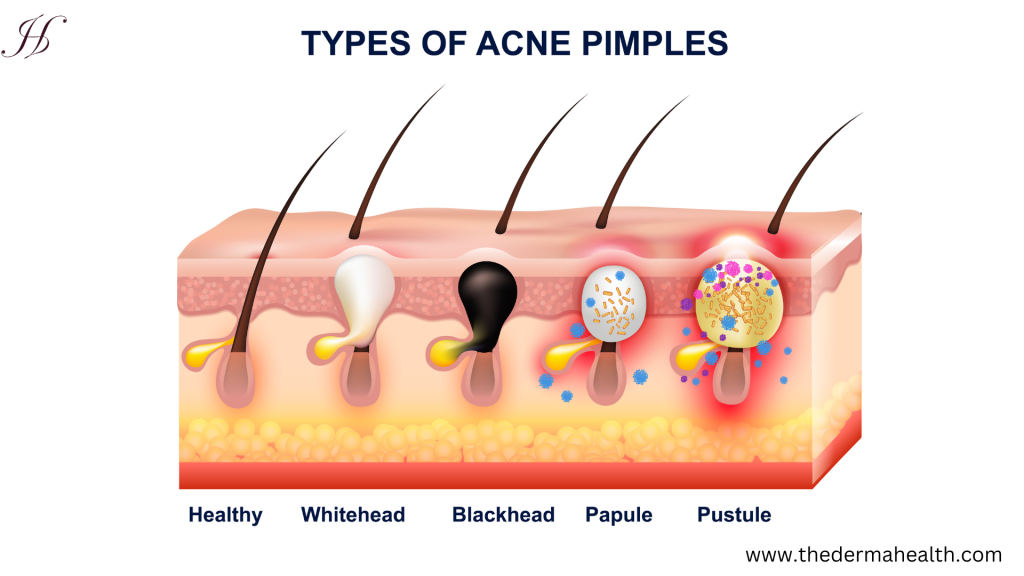 Acne